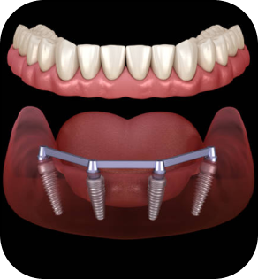 Dental Implants 3D Illustration